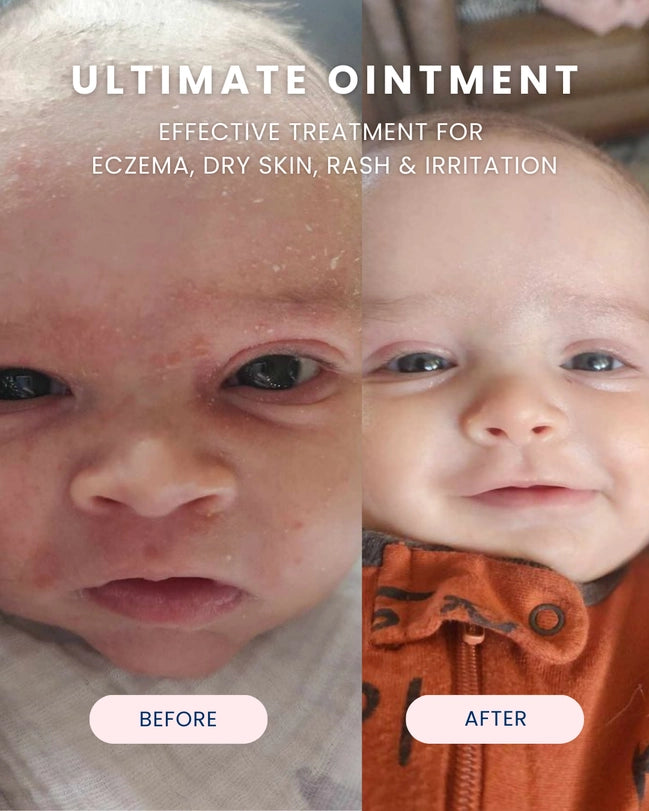 Digital photograph advertisement of a before and after facial skin treatment comparison of a baby at home, featuring the Ultimate Ointment header, red flaky eczema on the left, and smooth clear skin on the right with the child wearing an orange onesie